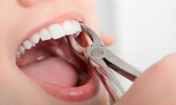 Mọi điều bạn cần biết về kìm nhổ răng số 8 hàm dưới 