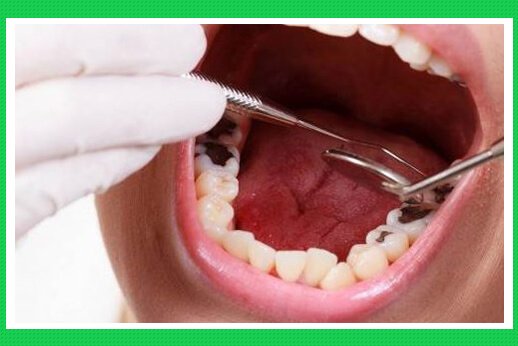 Sâu răng được phát triển như thế nào ?